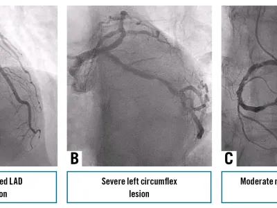 Bailout excimer laser coronary atherectomy for guidewire entrapment in a severely calcified left anterior descending artery complicated by dual perforation