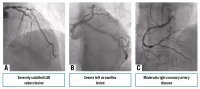 Bailout excimer laser coronary atherectomy for guidewire entrapment in a severely calcified left anterior descending artery complicated by dual perforation