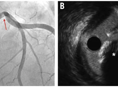 Successful retrieval of a calcified embolus from the left main using a stent retriever after surgical aortic valve replacement