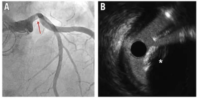 Successful retrieval of a calcified embolus from the left main using a stent retriever after surgical aortic valve replacement