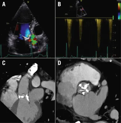 When a new murmur appears: the left-to-right dilemma – management of iatrogenic ventricular septal defect after transcatheter aortic valve implantation