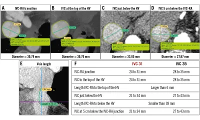 Percutaneous management of upward migration of an inferior vena cava prosthesis during implantation