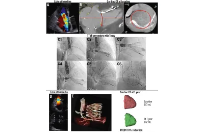 Transcatheter tricuspid valve replacement using a novel system in a patient with a right ventricular pacemaker lead