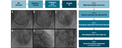 Transcatheter closure of an apical post-infarction ventricular septal rupture after delayed anterior myocardial infarction complicated by cardiogenic shock and ventricular tachycardia