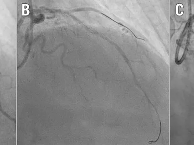 Fenestration and TAP stenting to restore side branch flow after covered stent implantation for coronary perforation