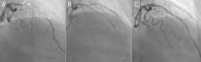Fenestration and TAP stenting to restore side branch flow after covered stent implantation for coronary perforation