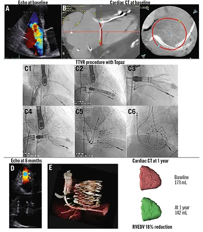 Topaz TTVR in patient with an RV lead