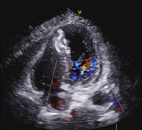 Post-MI VSR: a lethal crossroad