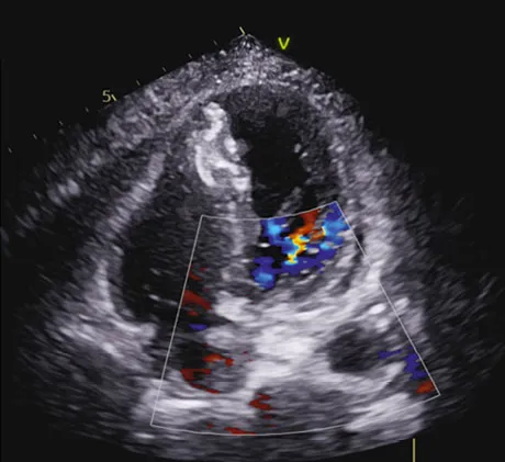 Post-MI VSR: a lethal crossroad